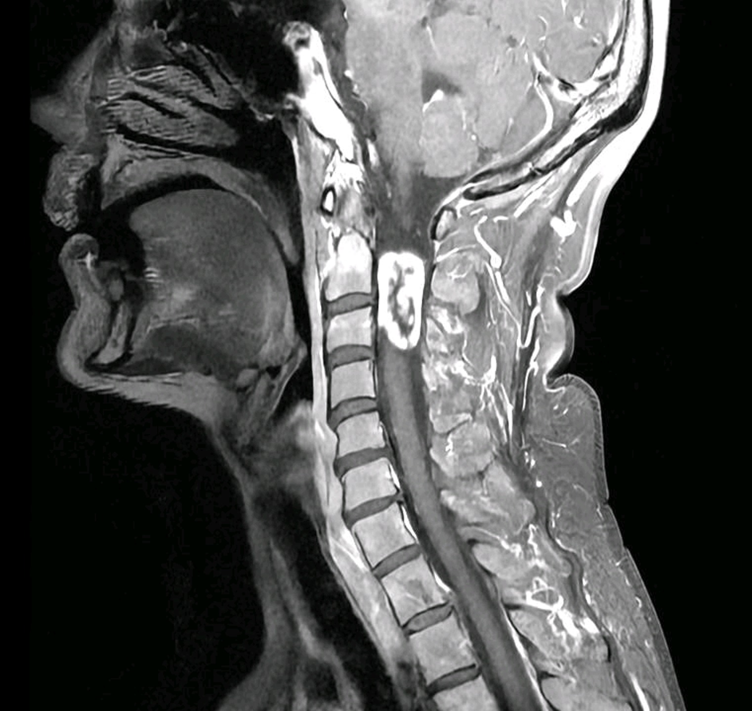 Tratamiento tumores columna Barcelona