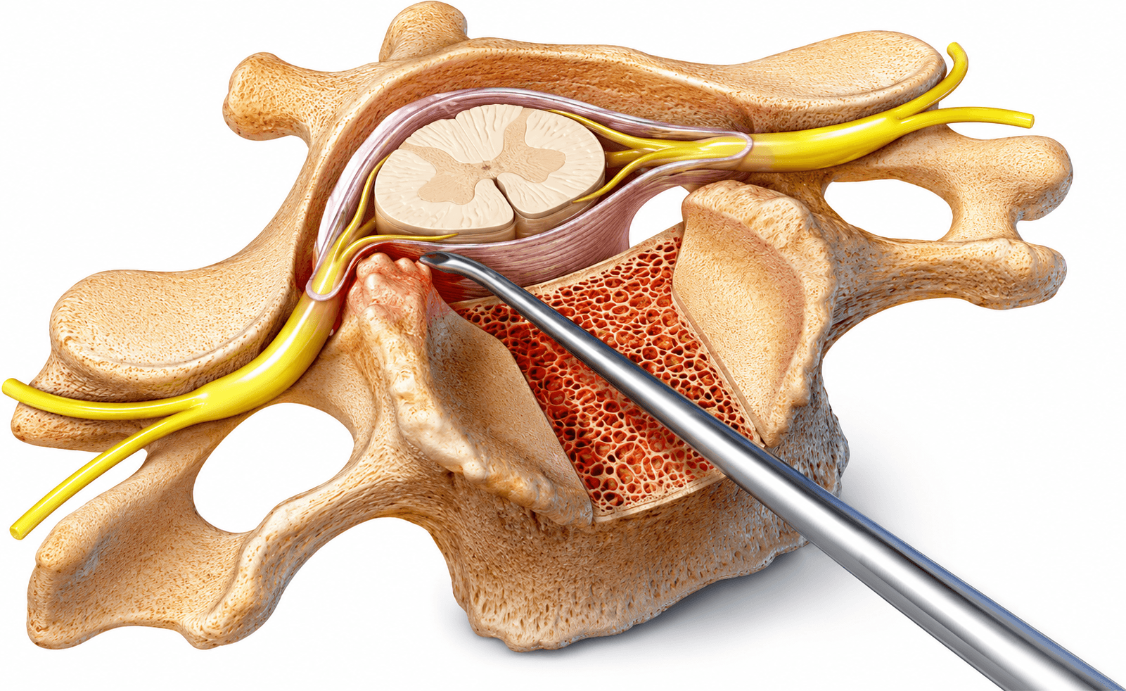 Estenosis del canal cervical Barcelona